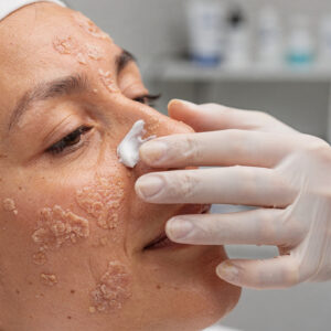 actinic keratosis treatment