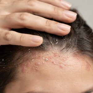 natural dandruff remedies