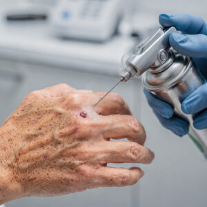 actinic keratosis treatment